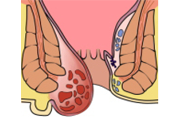 イボ痔 （痔核）
