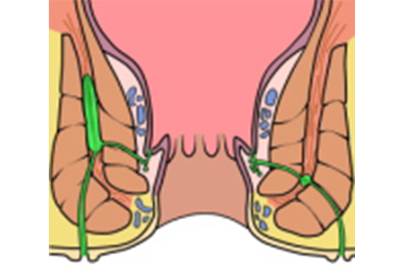 あな痔（痔瘻）