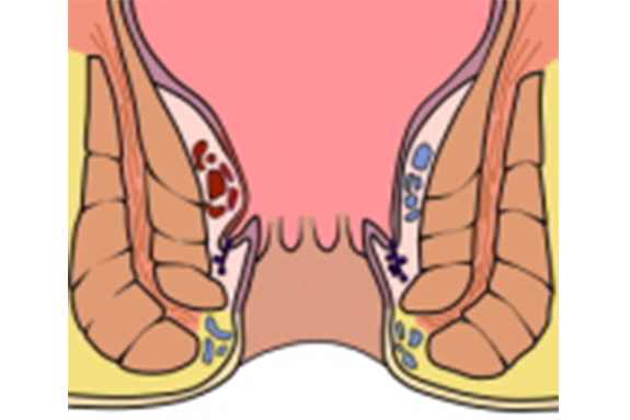 急性裂肛
