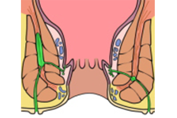 筋間痔瘻