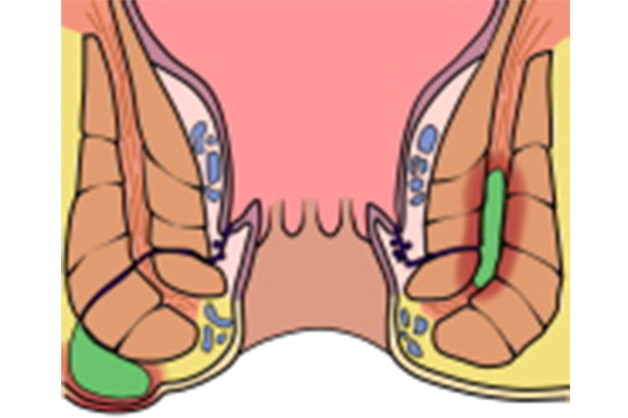 肛門周囲膿瘍