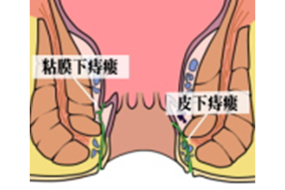 皮下/粘膜下痔瘻